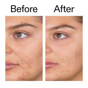 Before and after using Salicylic Acid Cleanser