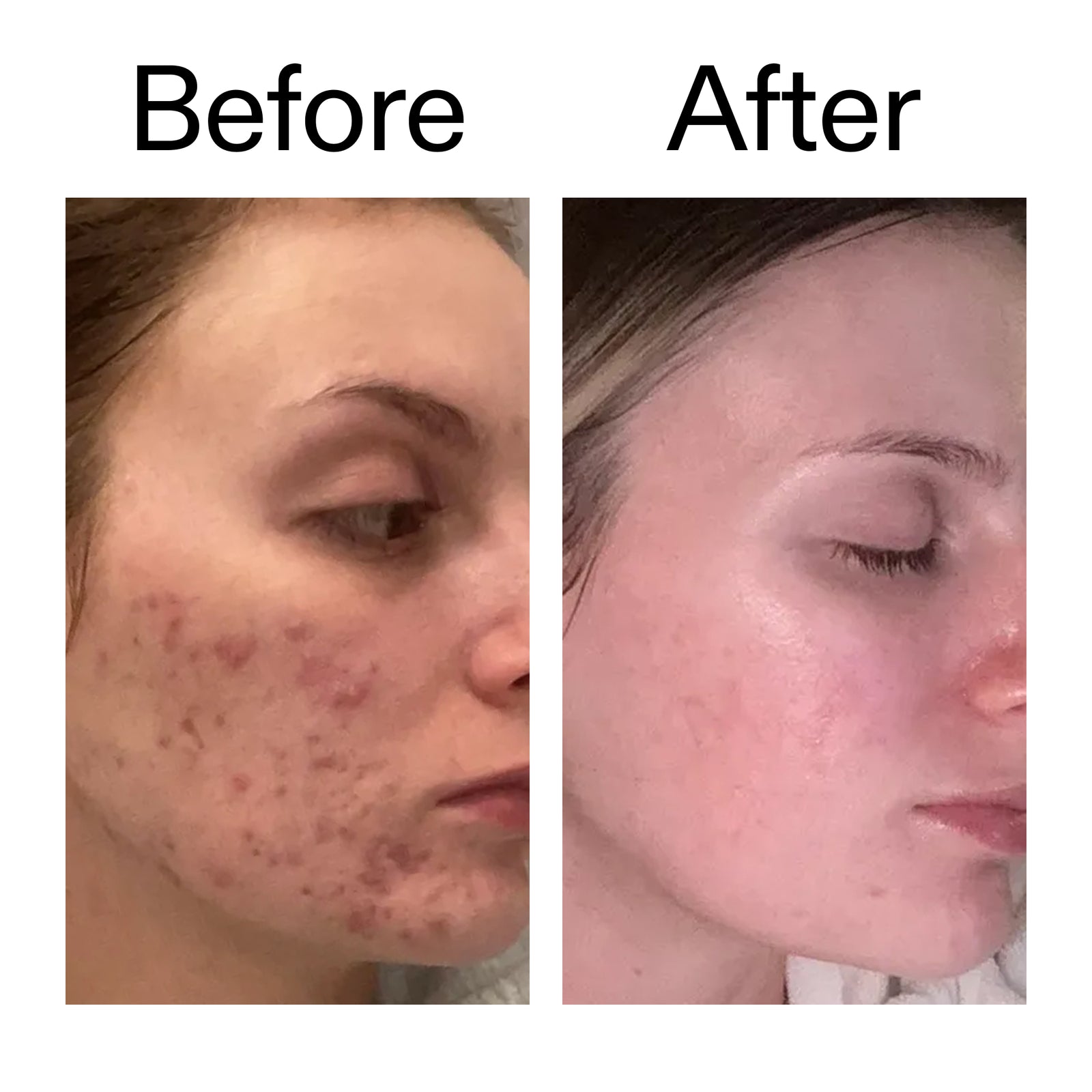 Before and after comparison of a woman's face showing acne improvement. The left 'Before' panel shows visible facial acne on the cheek, and the right 'After' panel shows clearer skin.