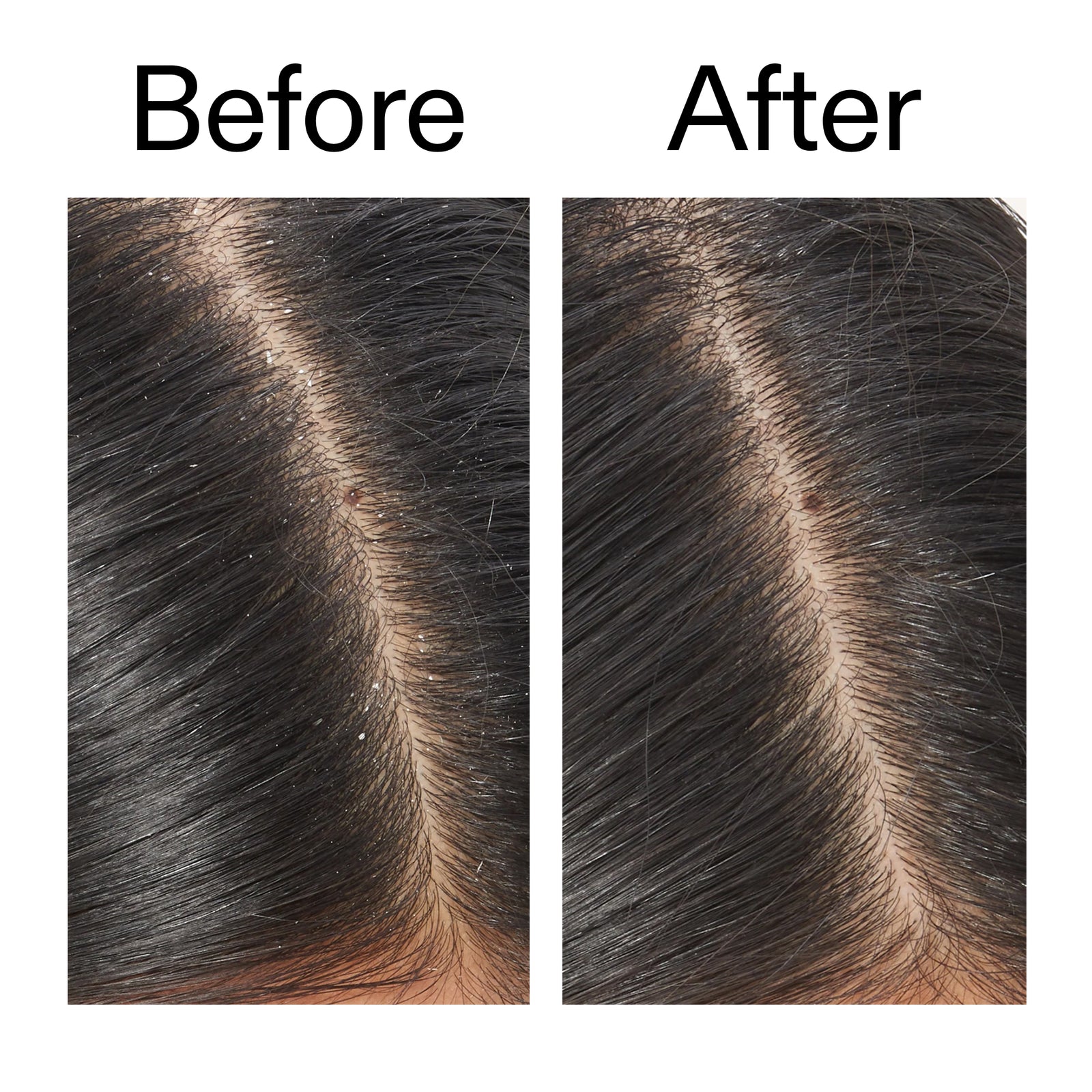 Before and after comparison of using Salicylic Acid Exfoliating Scalp Treatment