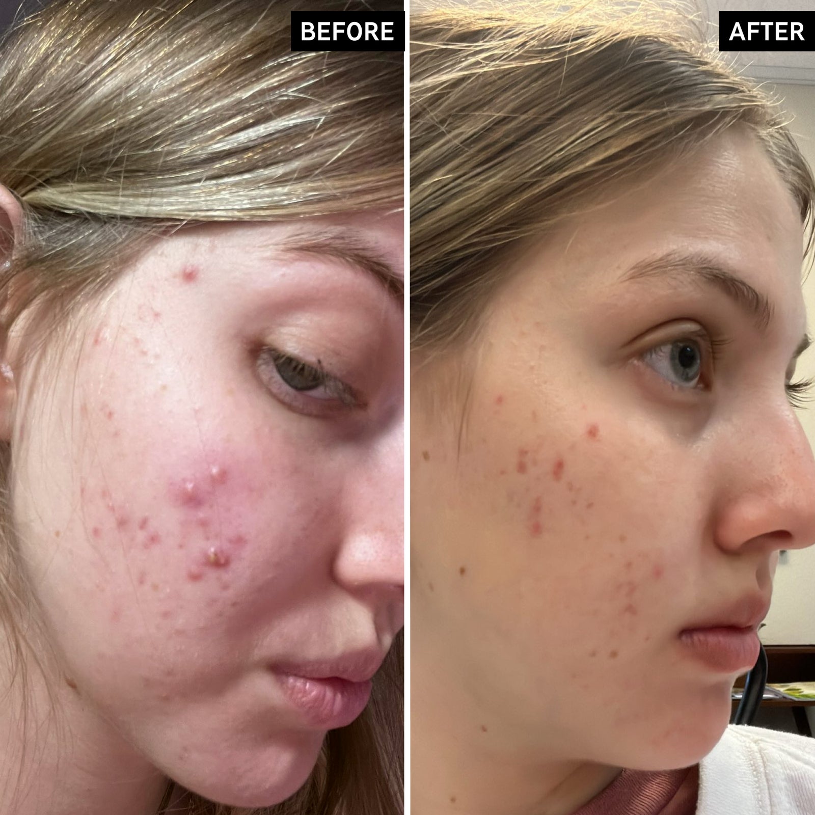 Before and after using Salicylic Acid Cleanser