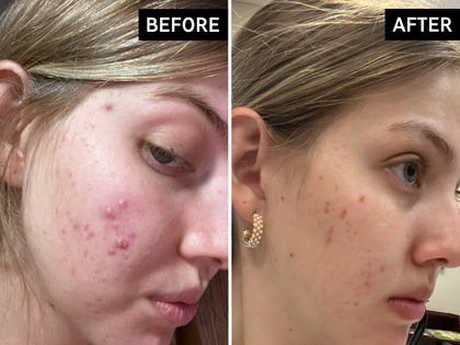 Before and after comparison of a person's face with acne on a plain background