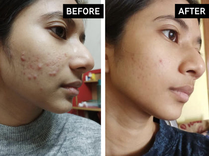 Before and after comparison of a person's face with visible acne.