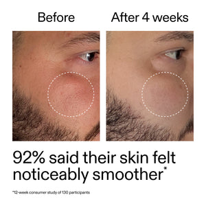 Before and after comparison of a man's skin with a visible improvement after 4 weeks.