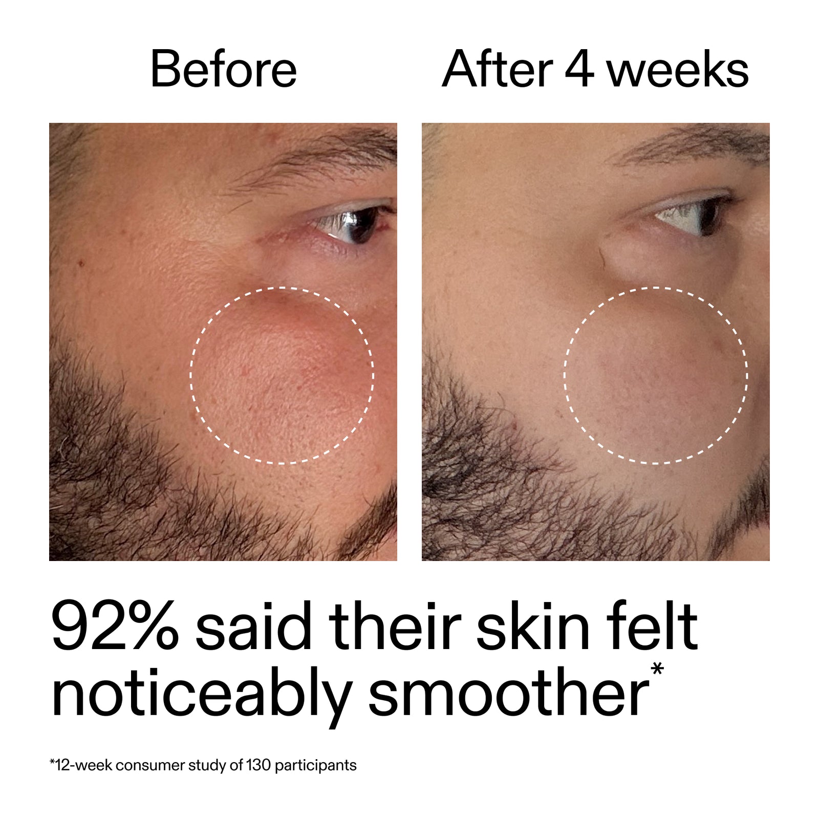 Before and after comparison of a man's skin with a visible improvement in texture.