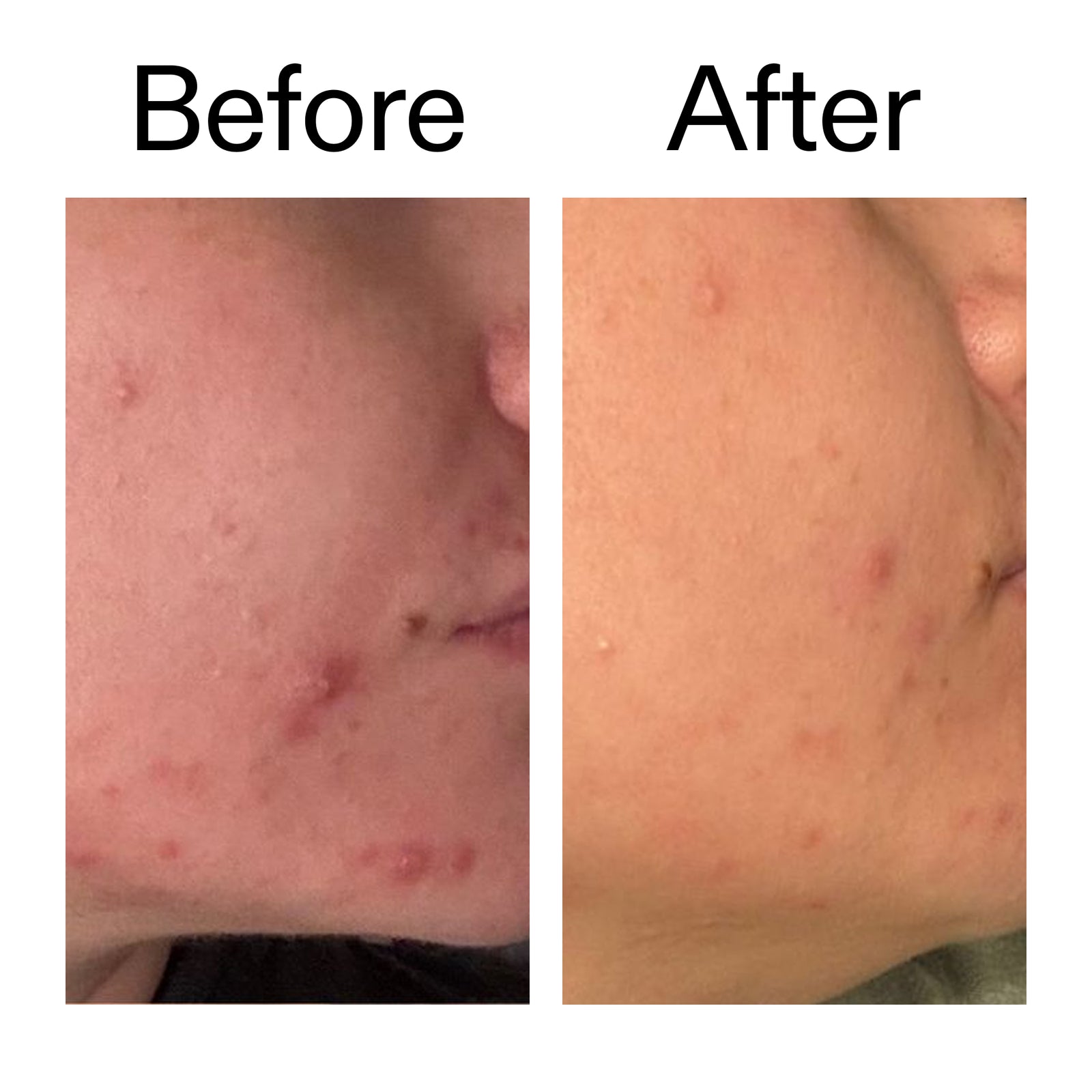A side-by-side before and after comparison of a person's cheek, showing acne and redness in the left panel and clearer skin in the right panel, with the words 'Before' and 'After' above the photos.