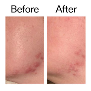 Before and after comparison of skin redness on a person's lower torso, showing visible red bumps in the 'Before' panel and reduced redness in the 'After' panel.