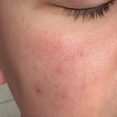 Close-up of a person's cheek showing red acne blemishes and skin texture.