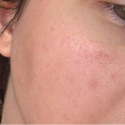 Close-up of a person's cheek and jawline showing skin texture and redness.