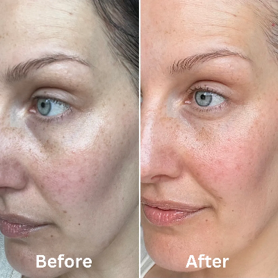 Before and after close-up facial comparison of a woman's face, showing skin improvement across the cheek and eye area, with the words 'Before' and 'After' at the bottom.