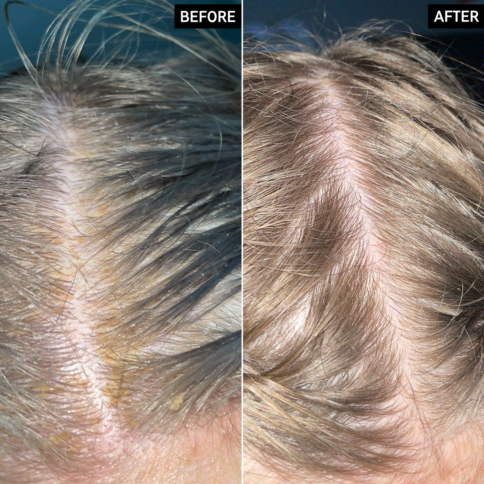 Before and after images of a scalp using Salicylic Acid Exfoliating Scalp Treatment