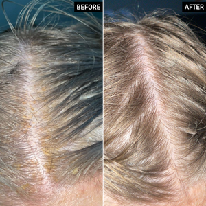 Before and after images of a scalp using Salicylic Acid Exfoliating Scalp Treatment