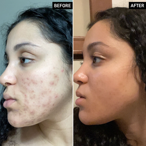 Before and After of customer using Tranexamic Acid Serum